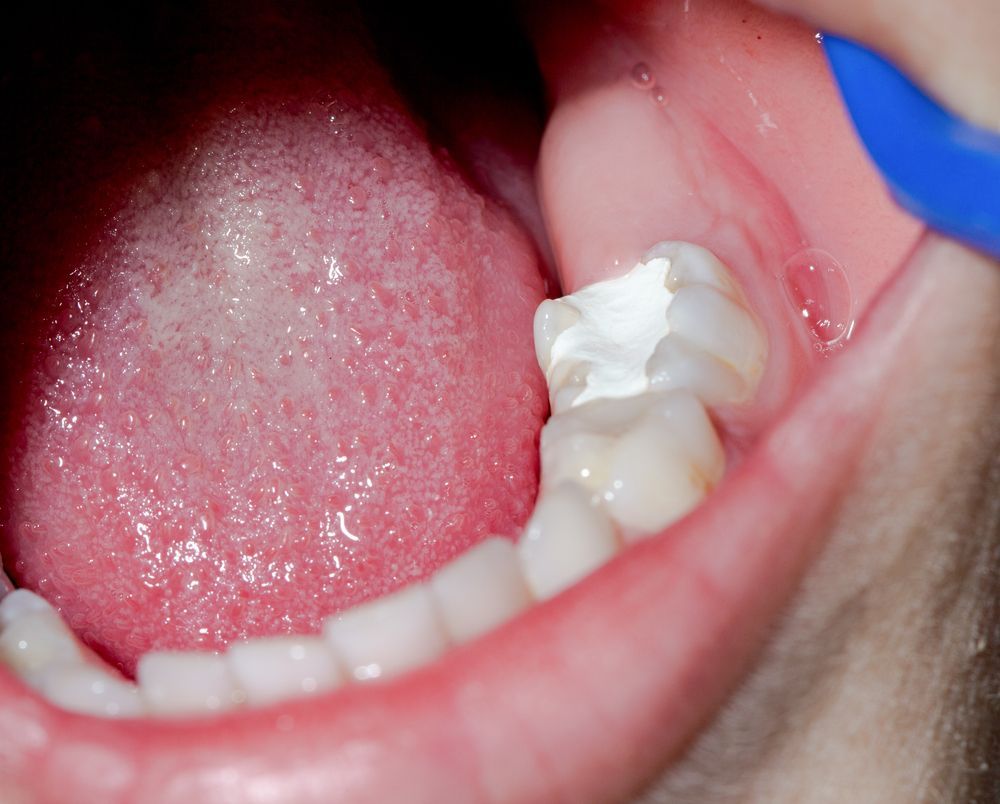 Mouth Interior Showing a Molar Tooth With a White Filling — Trower Dental In Casuarina, NT