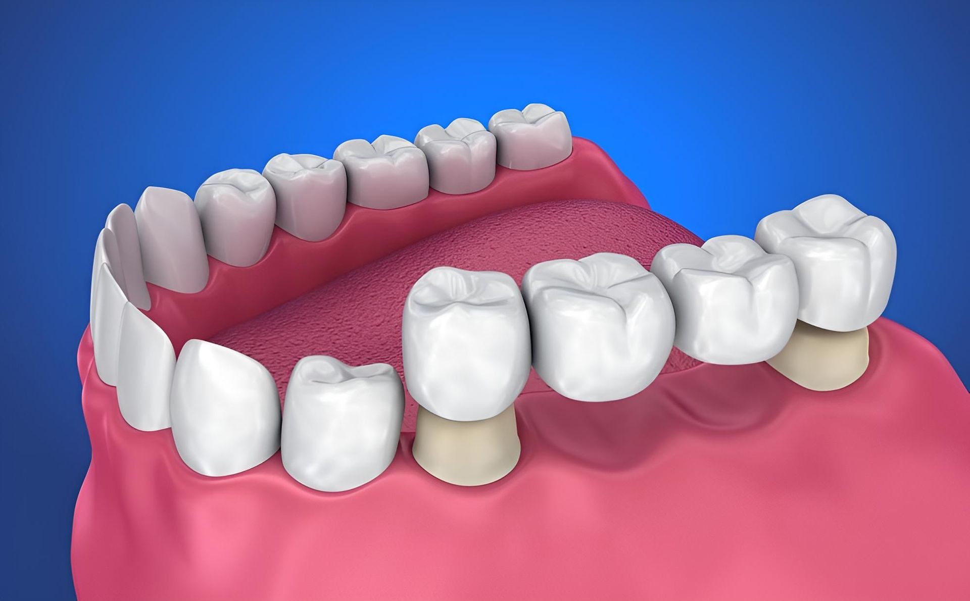 A Computer Generated Image of a Person 's Teeth and Gums — Trower Dental In Casuarina, NT