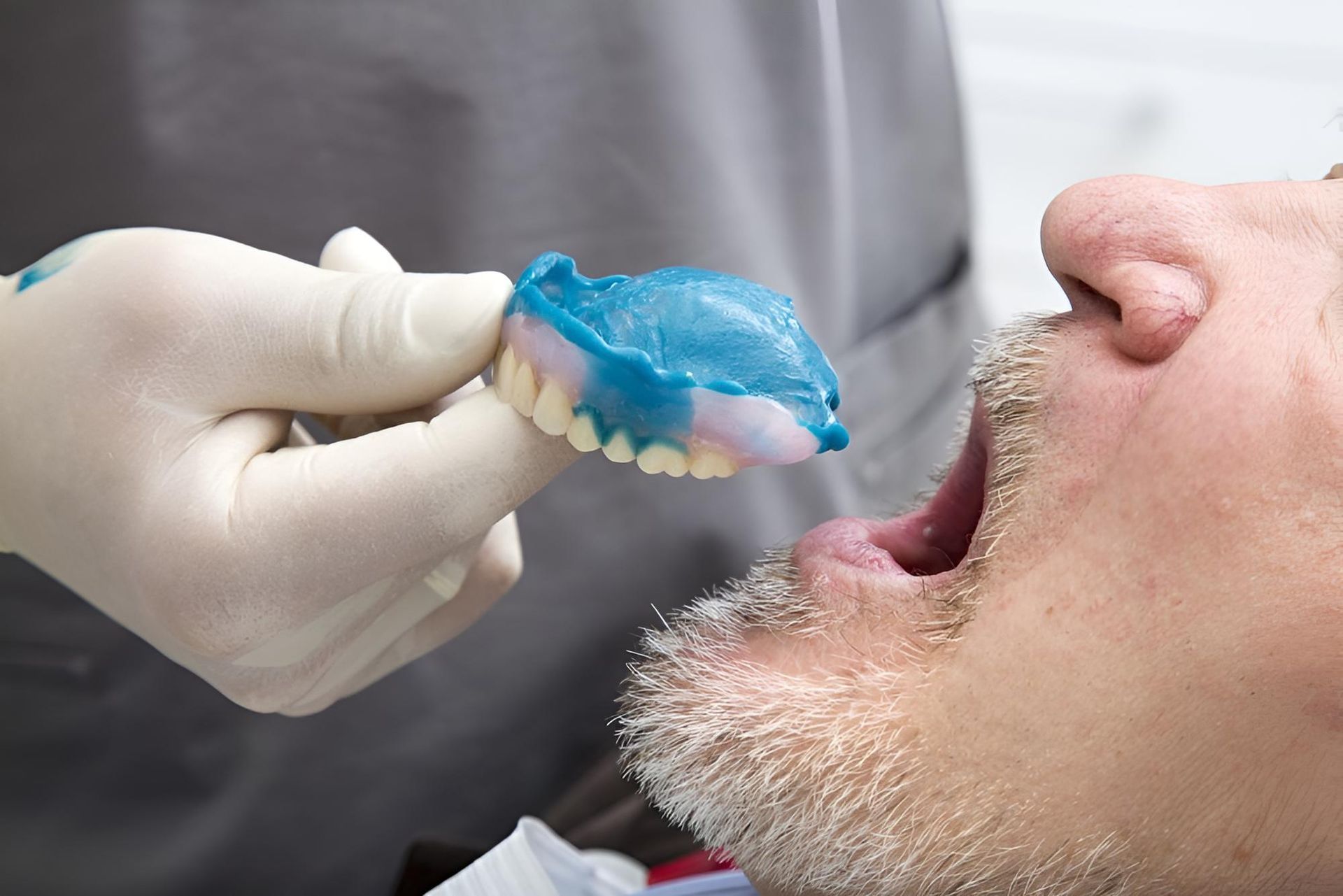 A dentist places a mold with blue dental material into an open-mouthed patient in a clinic. — Trower Dental In Casuarina, NT