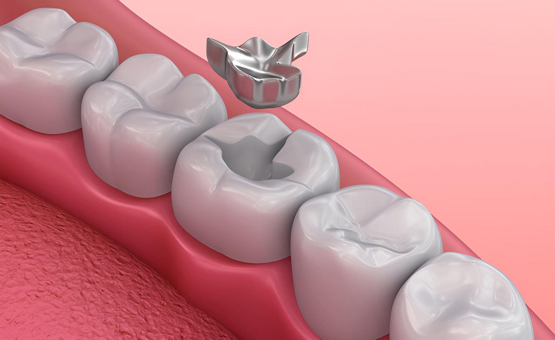 A Close Up of a Tooth With a Metal Inlay in It — Trower Dental In Casuarina, NT