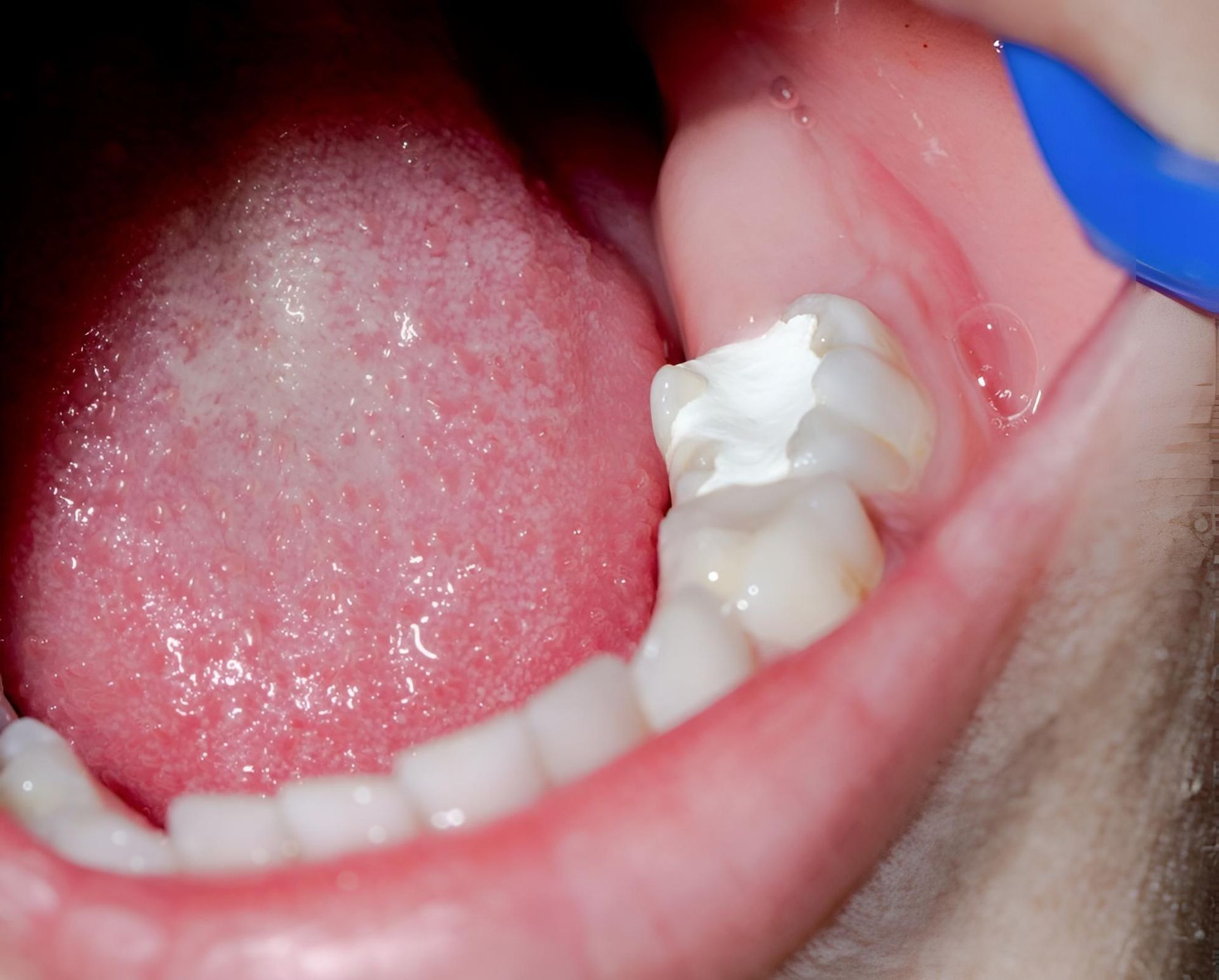 A Man is Getting His Teeth Examined by a Dentist — Trower Dental In Casuarina, NT