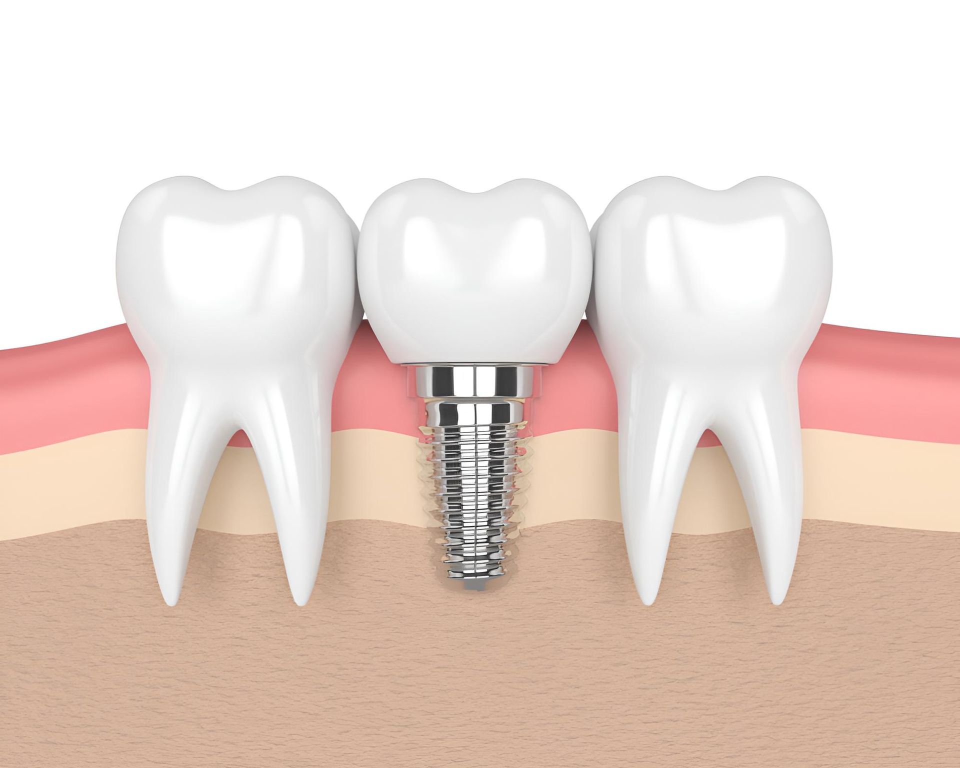 A 3D Rendering of a Dental Implant in a Row of Teeth — Trower Dental In Casuarina, NT