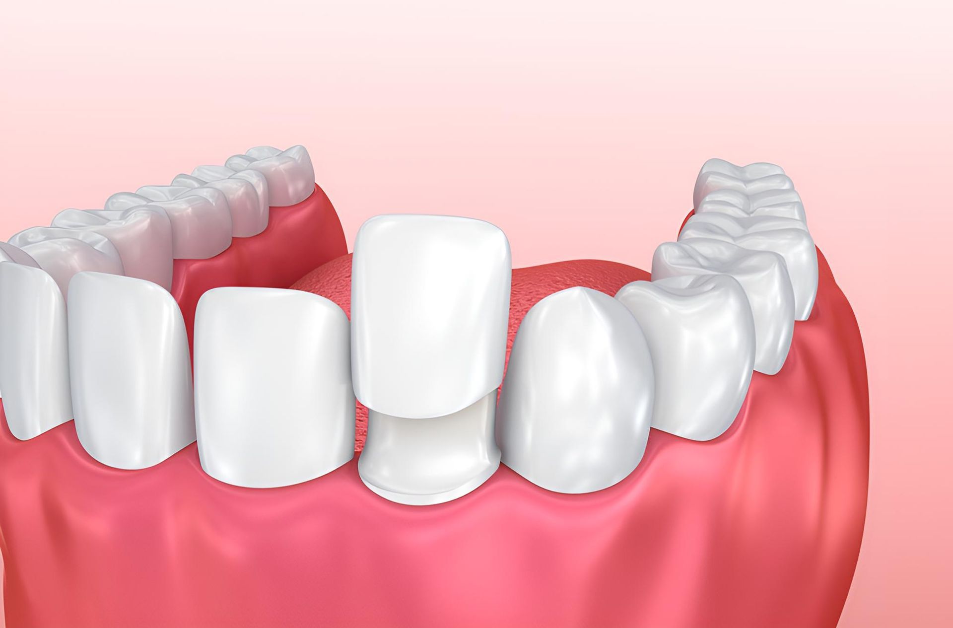 A Computer Generated Image of a Person's Teeth With Dental Crowns — Trower Dental In Casuarina, NT