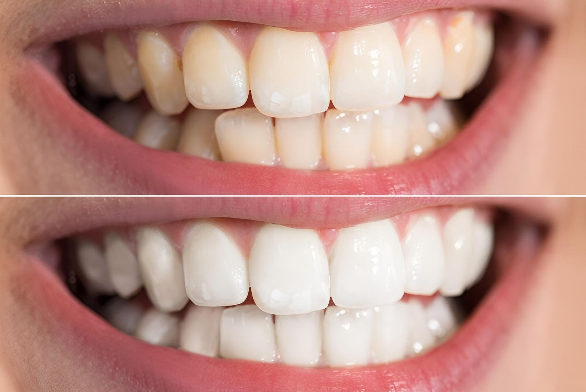 A Before and After Picture of a Person's Teeth — Trower Dental In Casuarina, NT