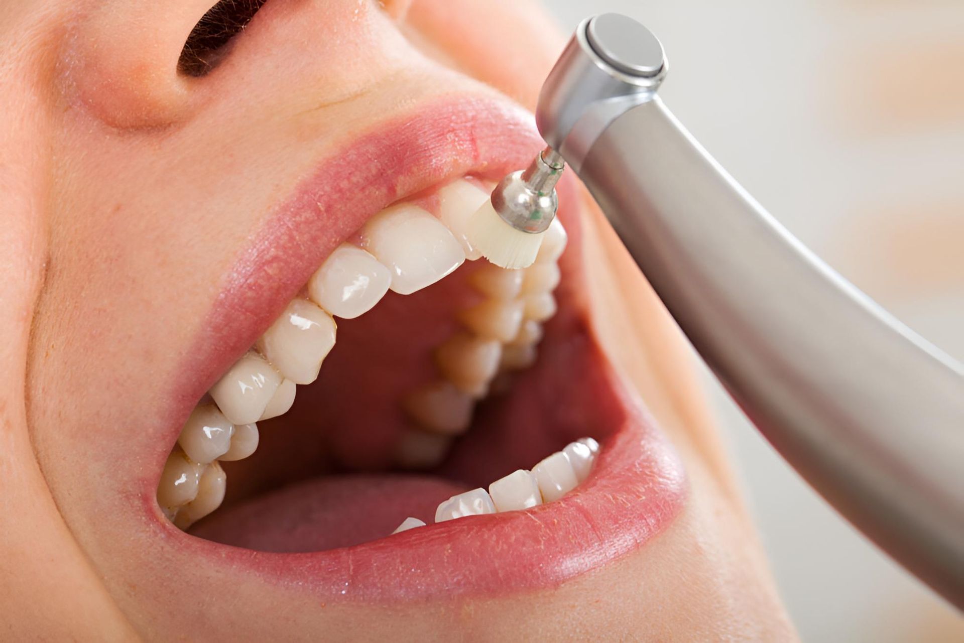 A Woman is Getting Her Teeth Cleaned by a Dentist — Trower Dental In Casuarina, NT