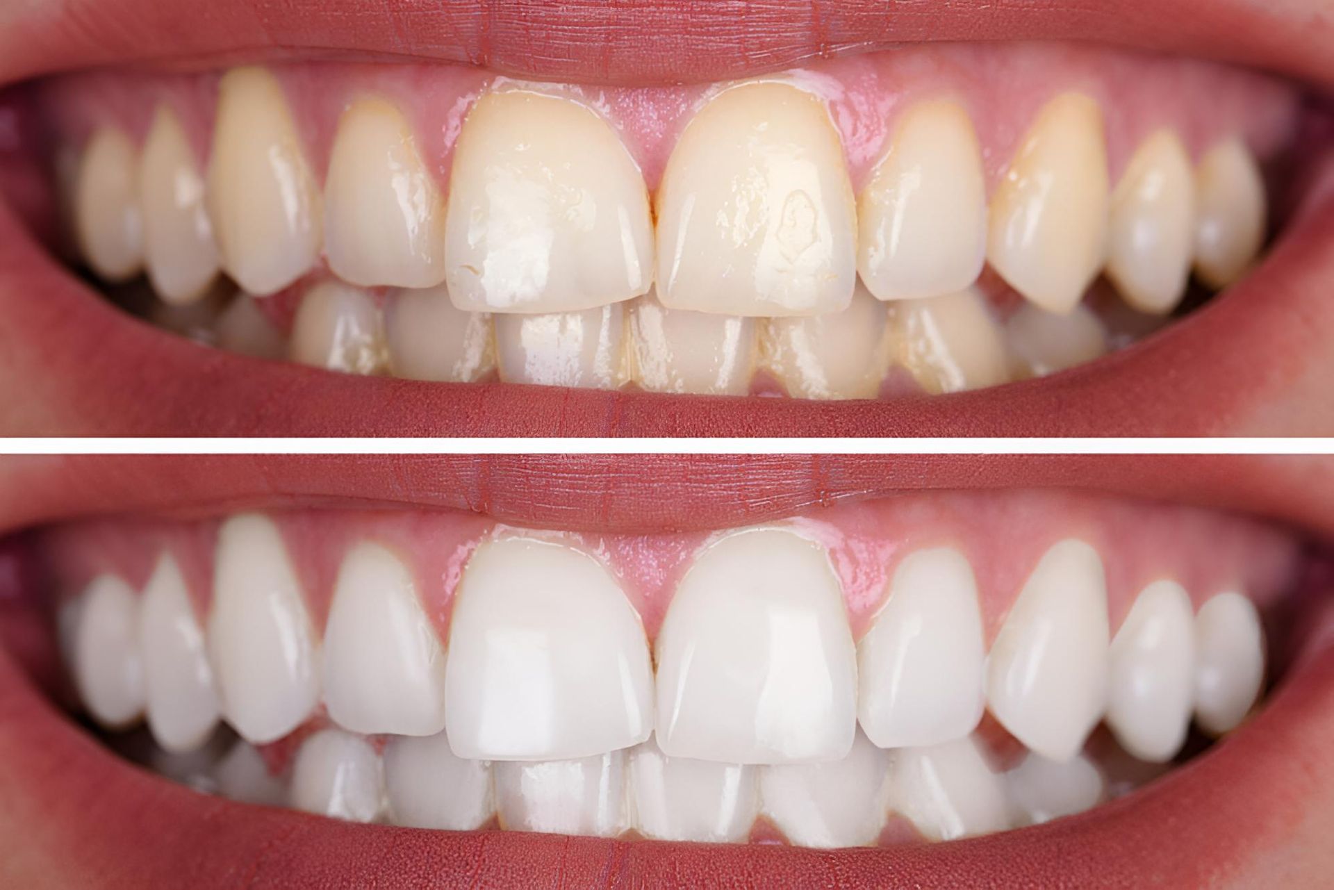 A Before and After Photo of a Person's Teeth — Trower Dental In Darwin, NT