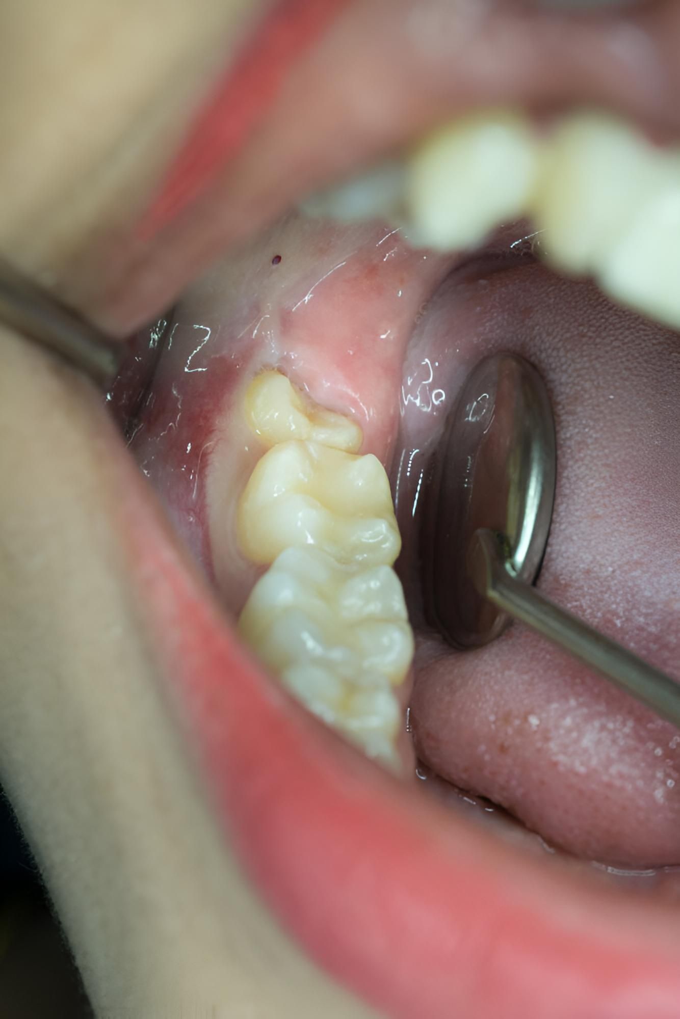 A Close Up of a Person's Mouth With a Dental Mirror in It — Trower Dental In Casuarina, NT