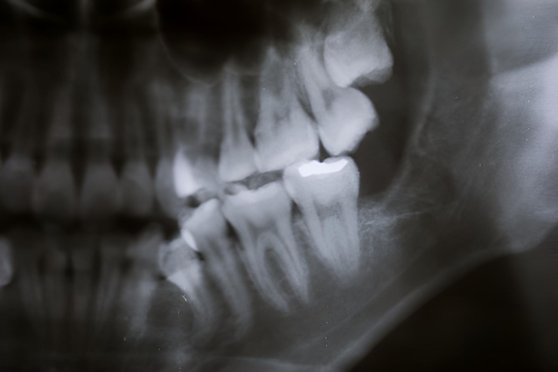 A Black and White X-ray of a Person's Teeth — Trower Dental In Casuarina, NT