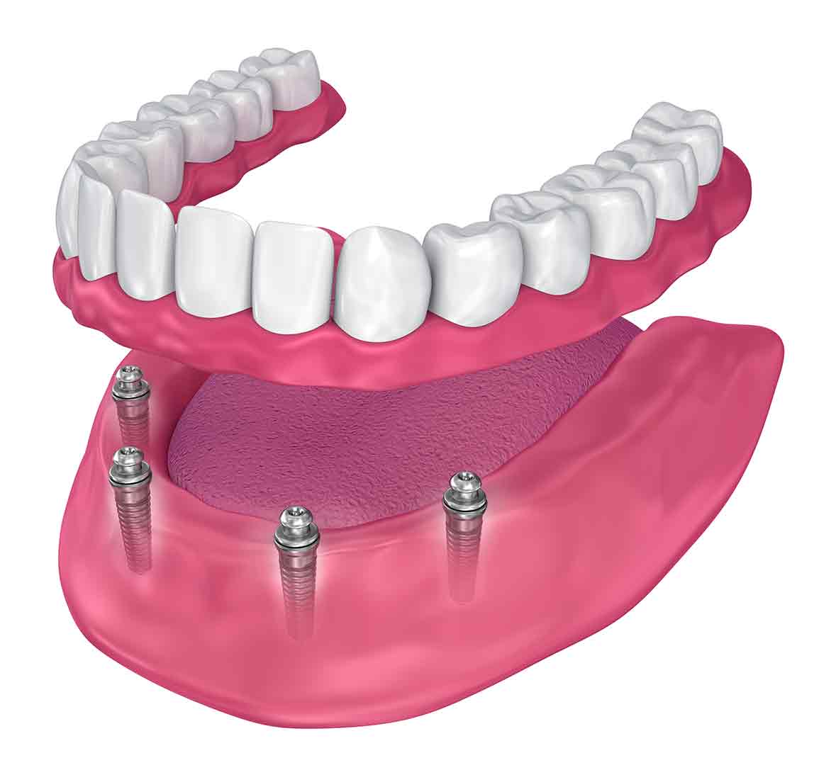 Ball Attachment On Dentures — Custom Denture Services in Maroochydore, QLD