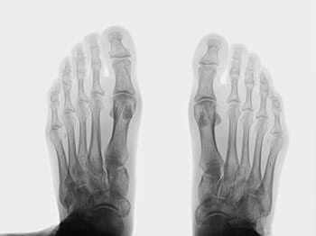 Foot Xray — Foot Doctor in Lakewood, OH Foot Xray — Foot Doctor in Lakewood, OH