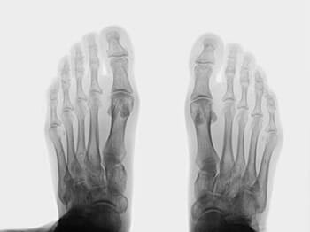 Foot Xray — Foot Doctor in Lakewood, OH