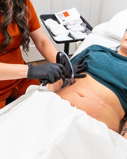 A woman is laying on a bed getting a treatment on her stomach.