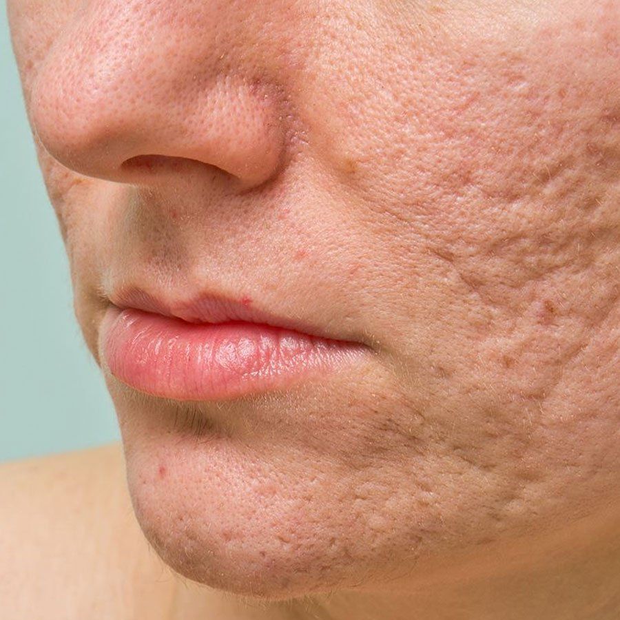 acne e lesioni post-acneiche