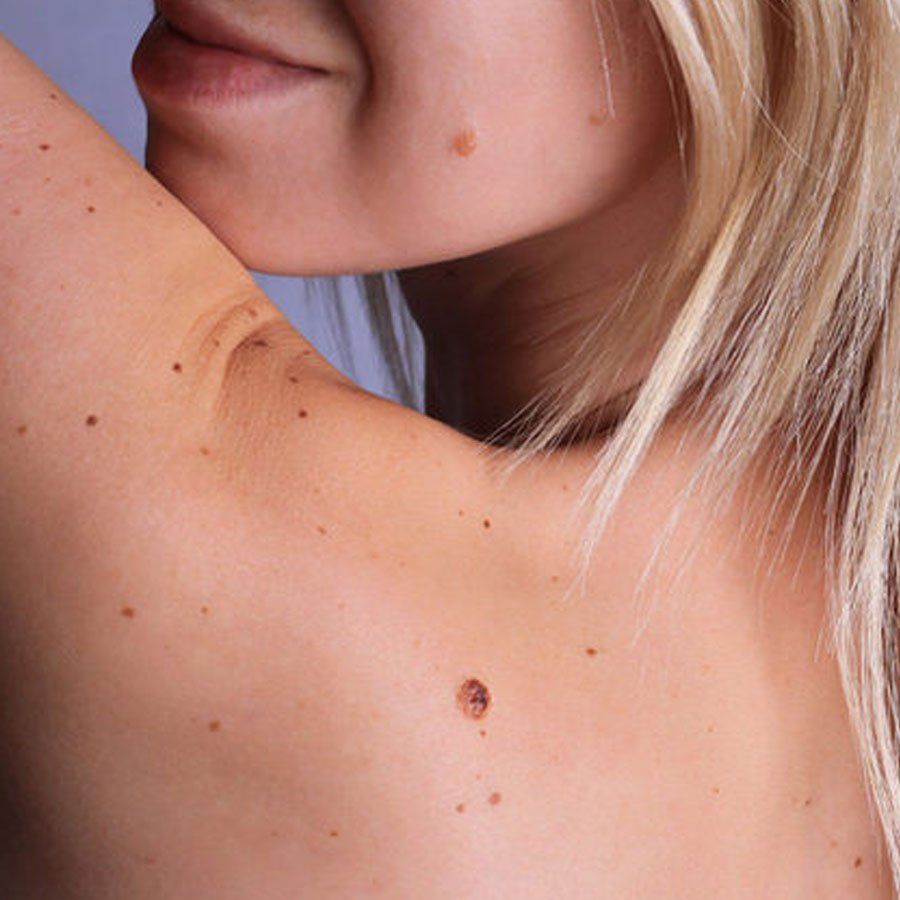 controllo dei nei ed asportazione