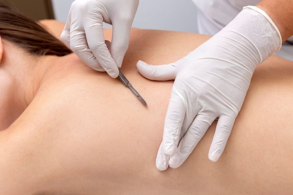 Person's back with gloved hands holding a scalpel. A medical procedure is being performed on the skin.