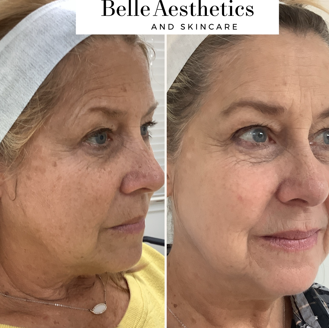 A BBL laser before and after photo of a woman's face - right profile.