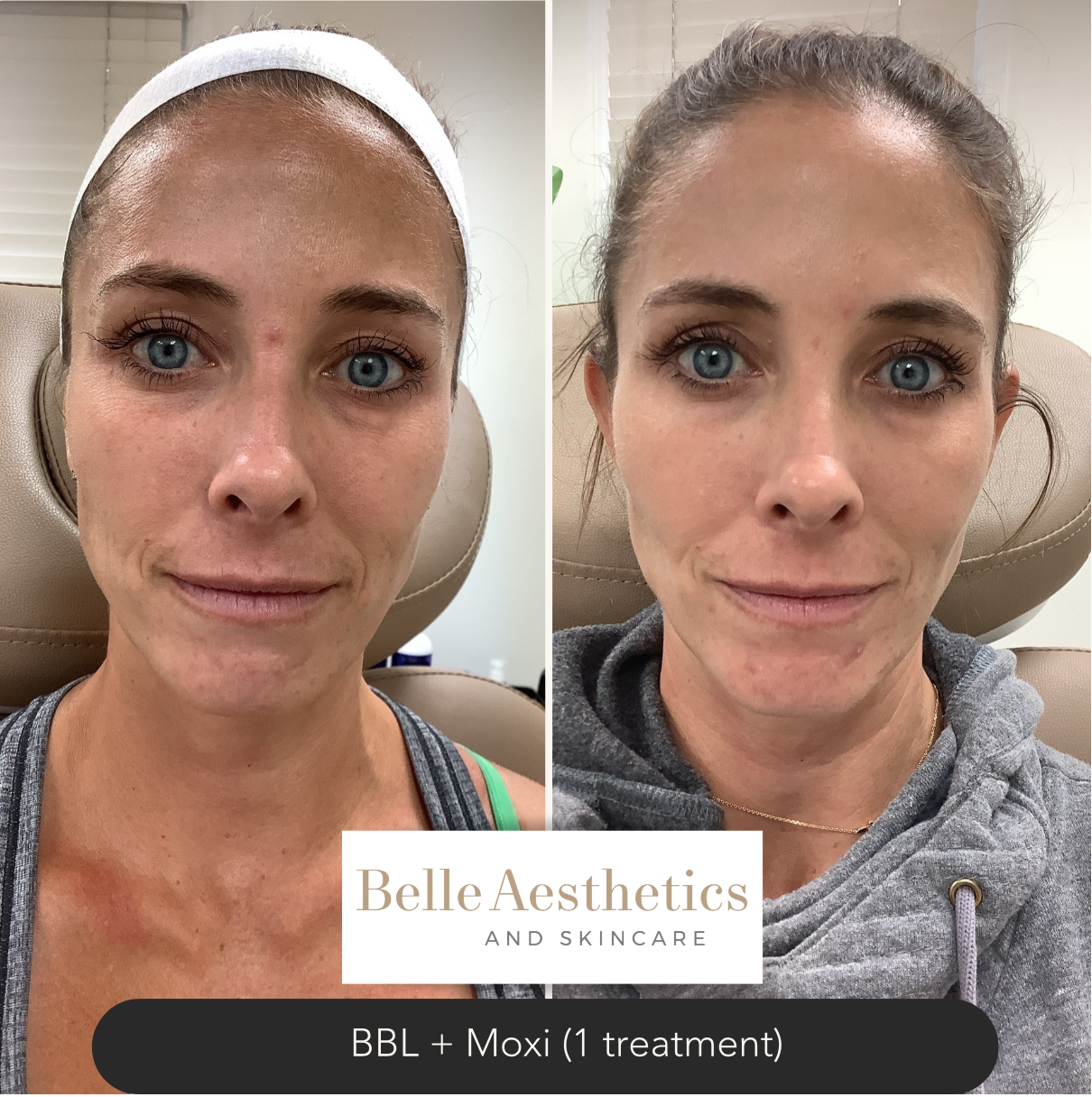 A Moxi and BBL laser before and after photo of a woman's face.