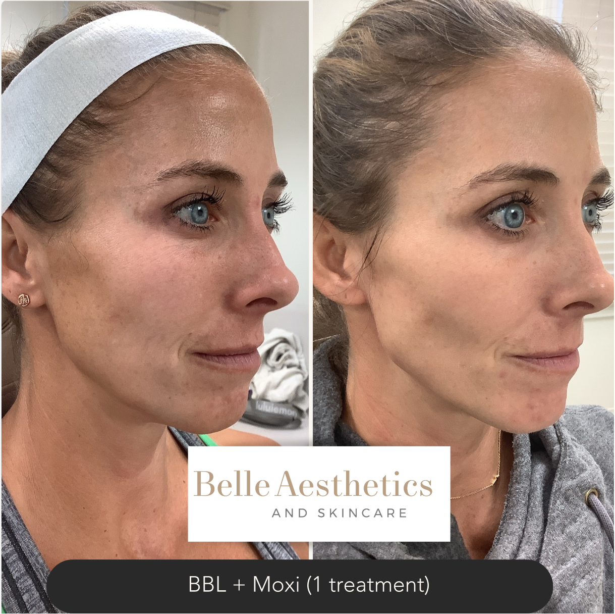 A Moxi and BBL laser before and after photo of a woman's face.