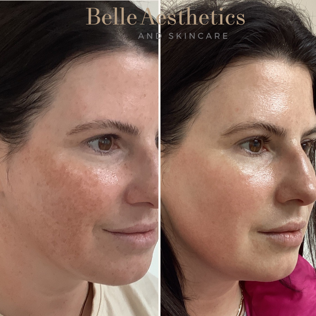 A before and after photo of a woman's face after a laser treatment of Moxi and BBL