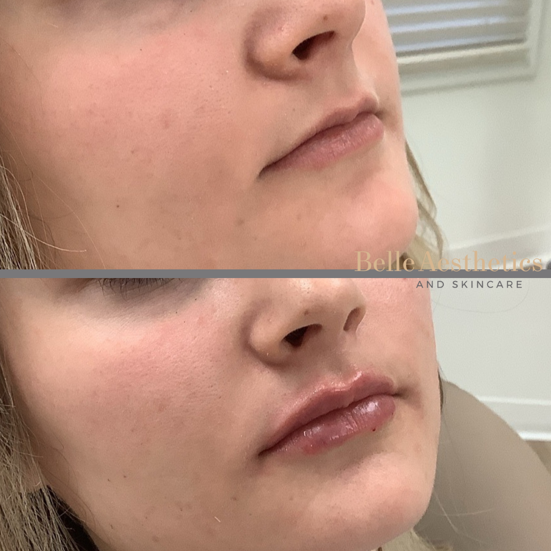 A before and after photo of a lip filler treatment.