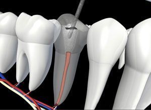 Endodontic Retreatment