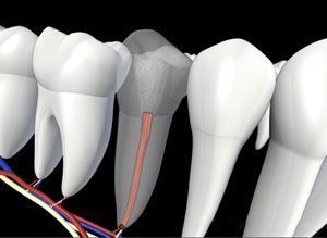 Endodontic Retreatment