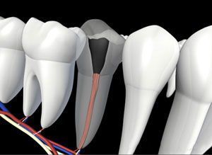 Endodontic Retreatment
