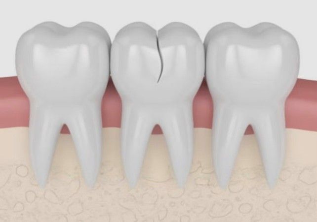 Illustration of a cracked tooth