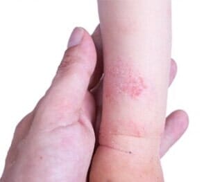 Eczema — pediatrics | Rocky Mount NC