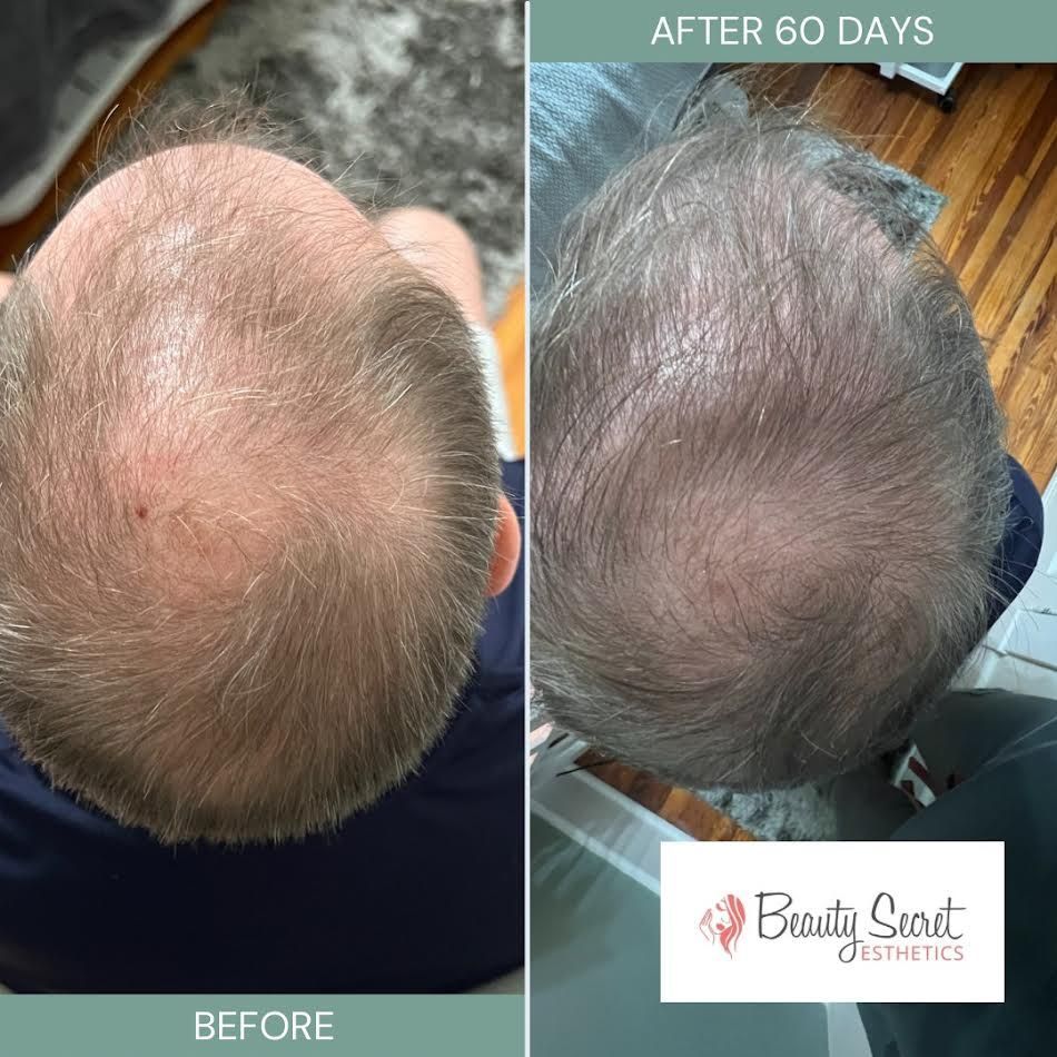 A before and after photo of a man 's hair growth.