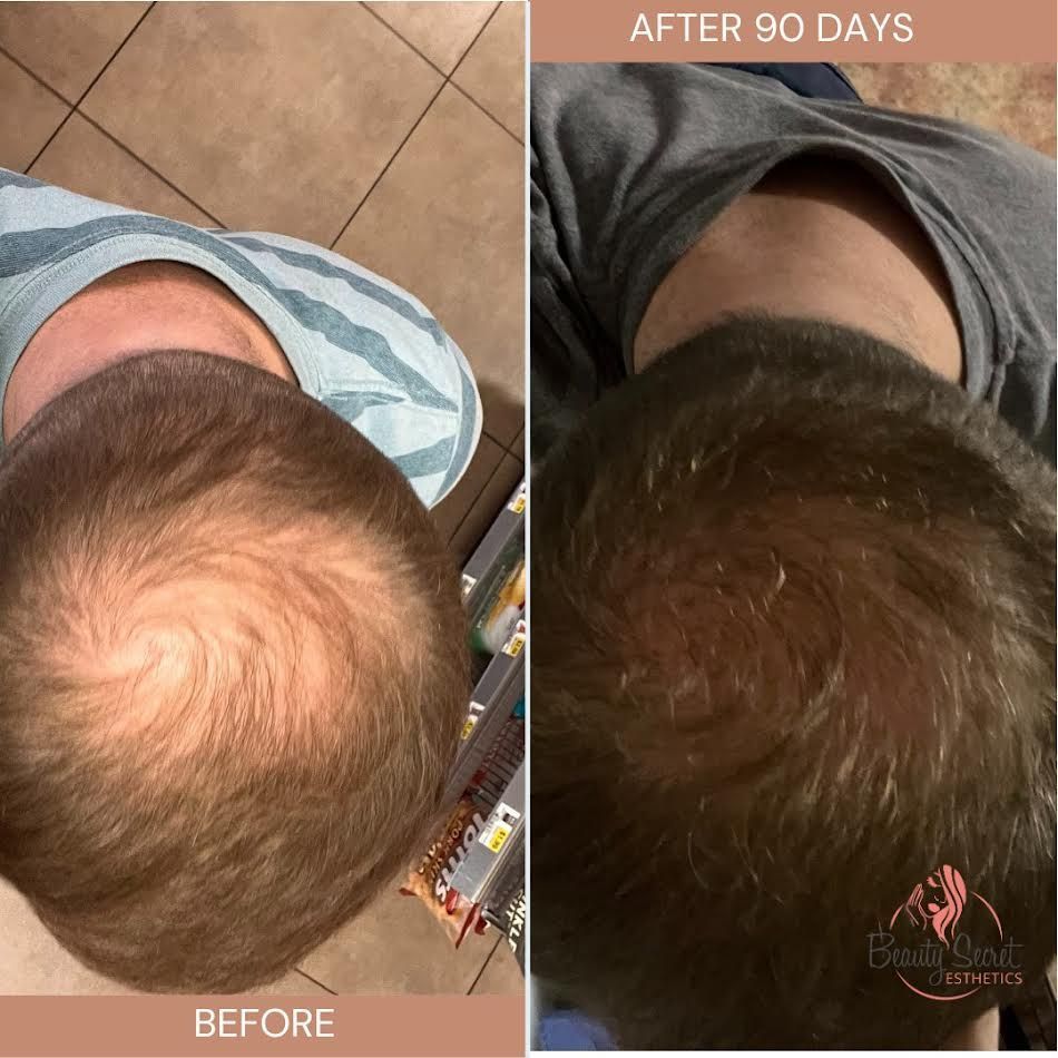 A man 's head is shown before and after 90 days.