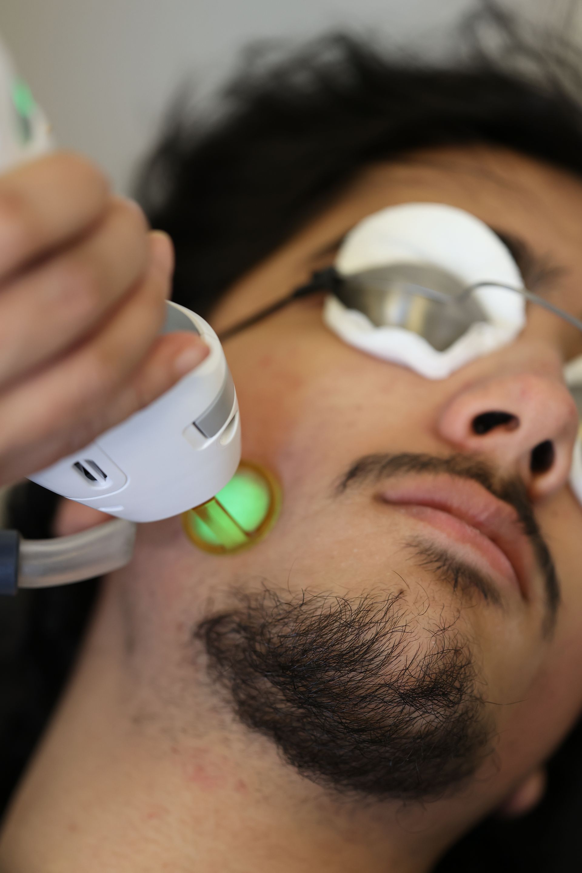 Laser treatment being applied to a man’s cheek and jawline during a facial procedure
