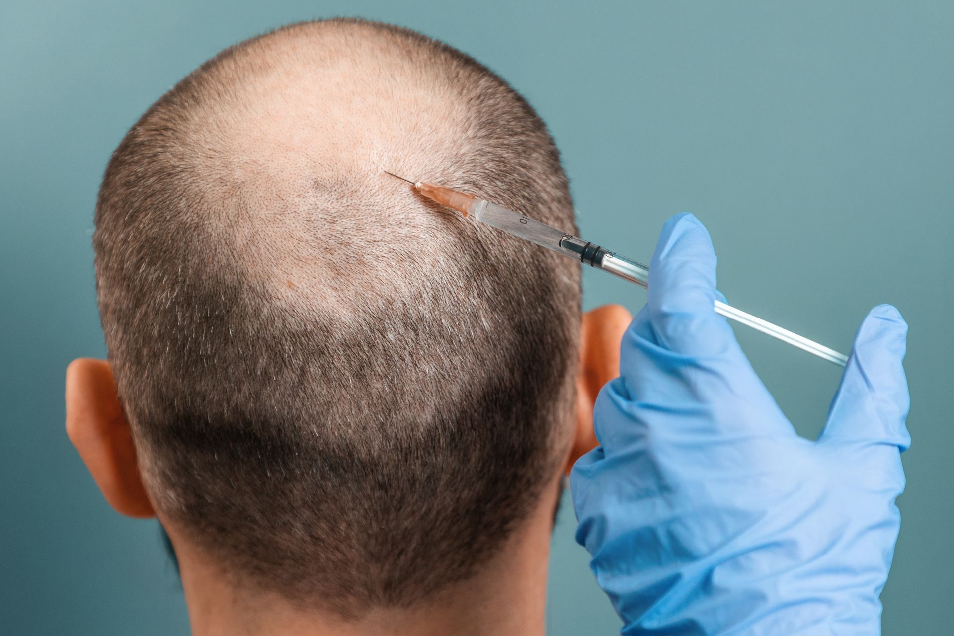 Gloved hand injects scalp on the back of a bald man’s head with a syringe