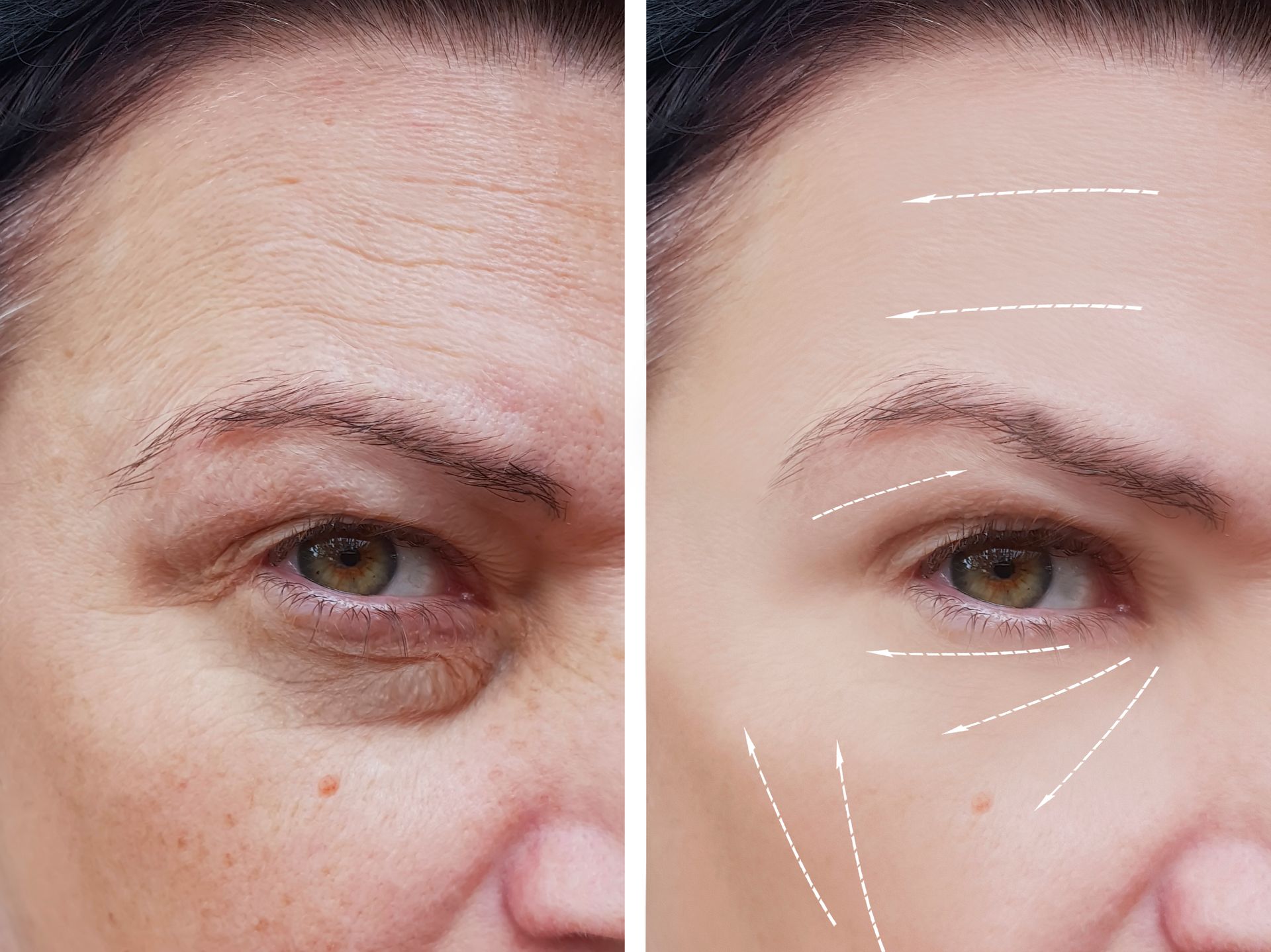 Close-up face split view showing eye-area wrinkles on the left and smoothed skin with contour lines on the right