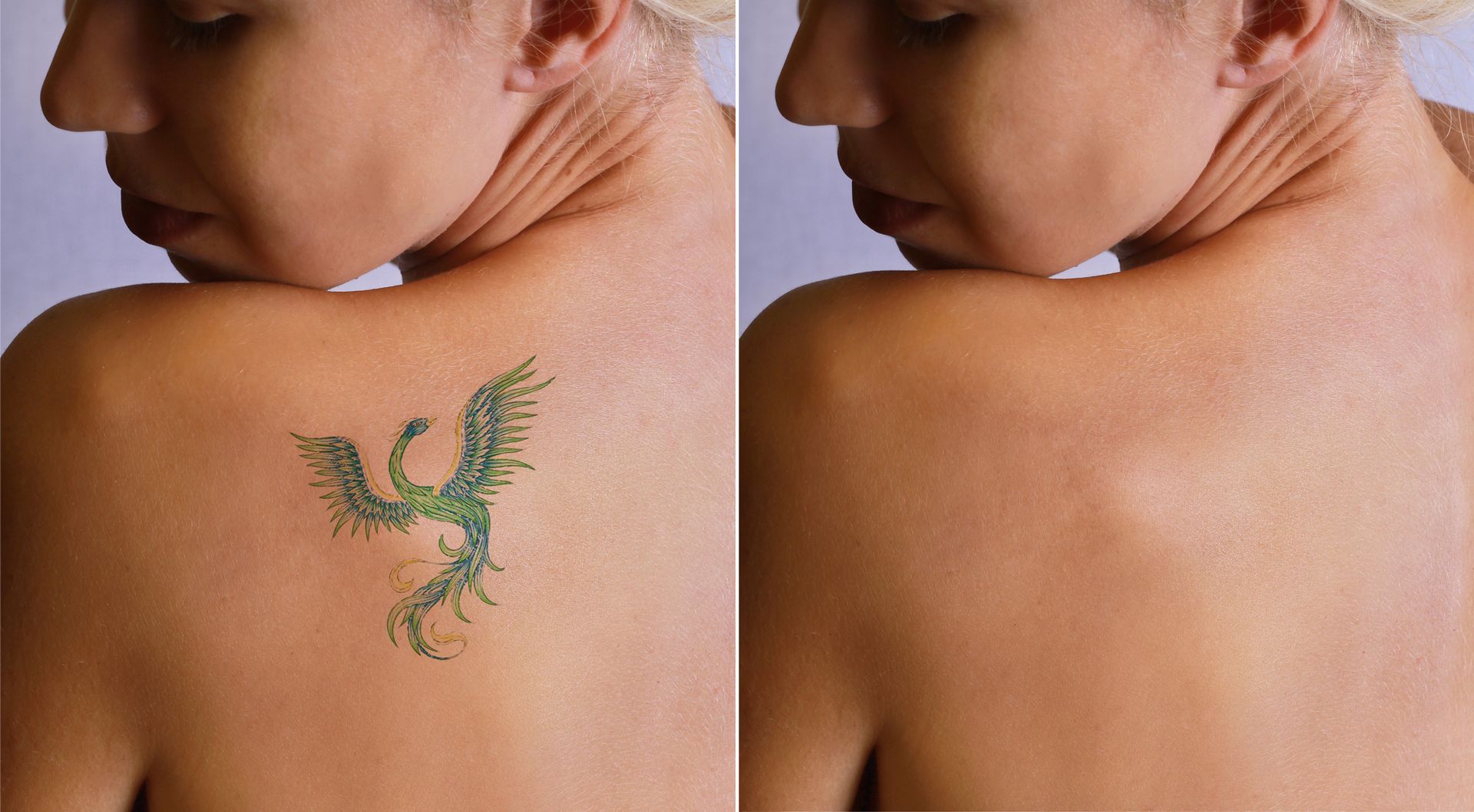 Side-by-side close-up of a woman's upper back, showing a tattoo before and after removal or fading