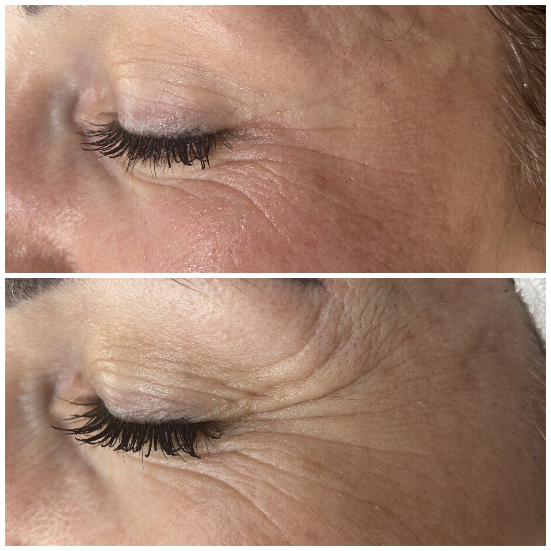 Ein Vorher-Nachher-Foto des Gesichts einer Frau mit Falten.