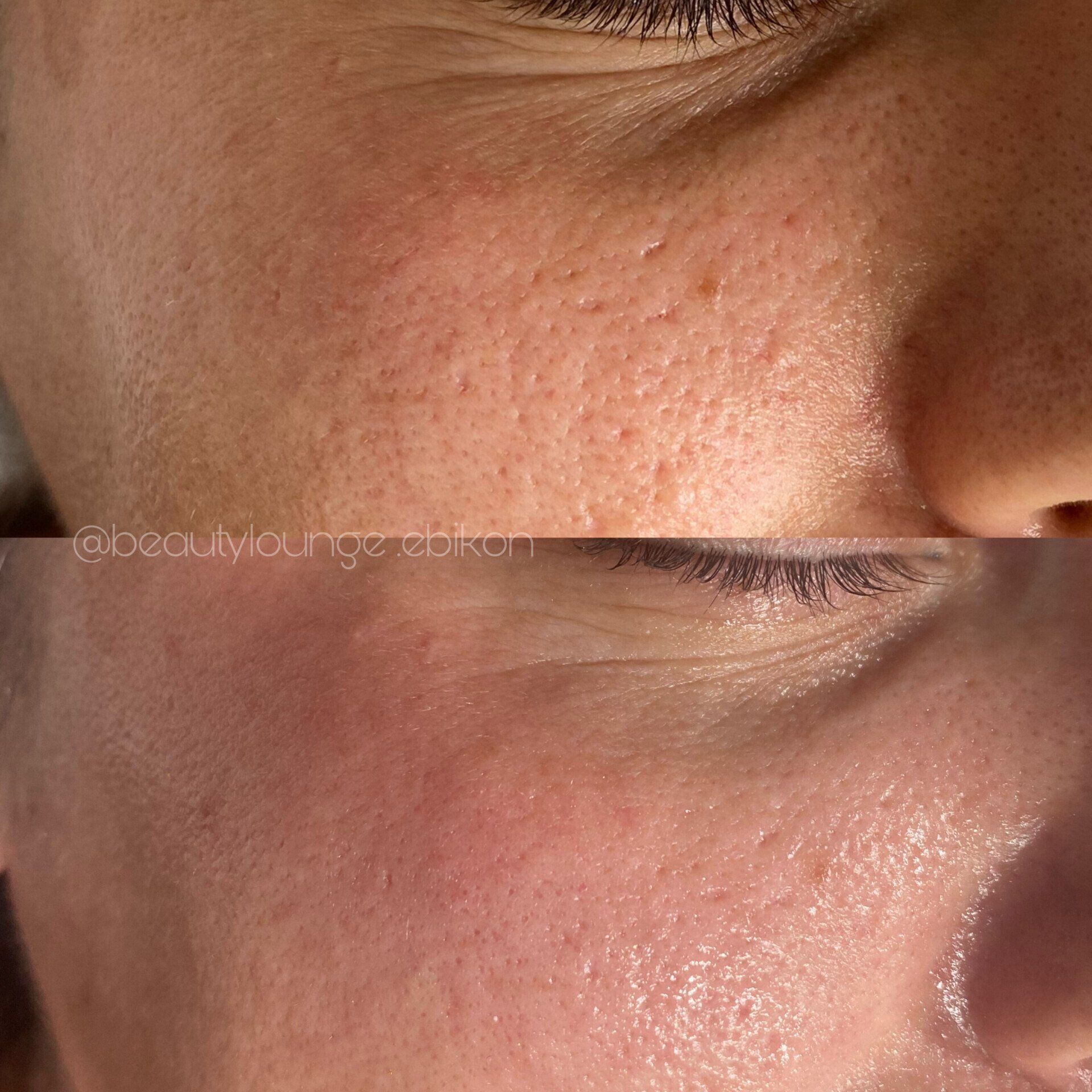 Das Gesicht einer Frau wird vor und nach einer Behandlung gezeigt.