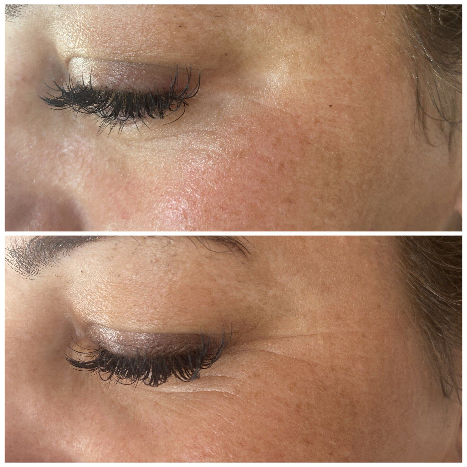 Ein Vorher-Nachher-Foto des Gesichts einer Frau.