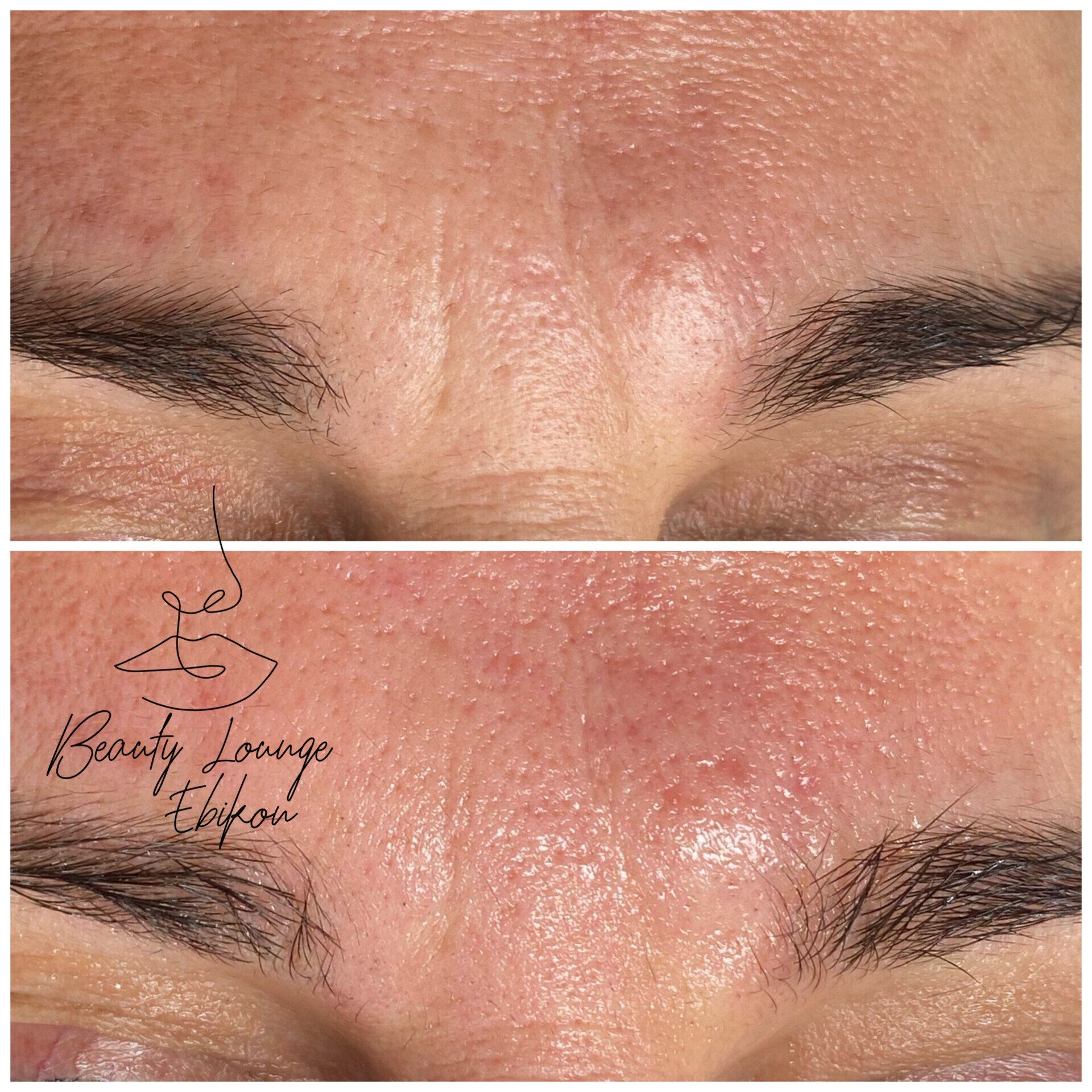 Ein Vorher-Nachher-Foto der Stirn einer Frau