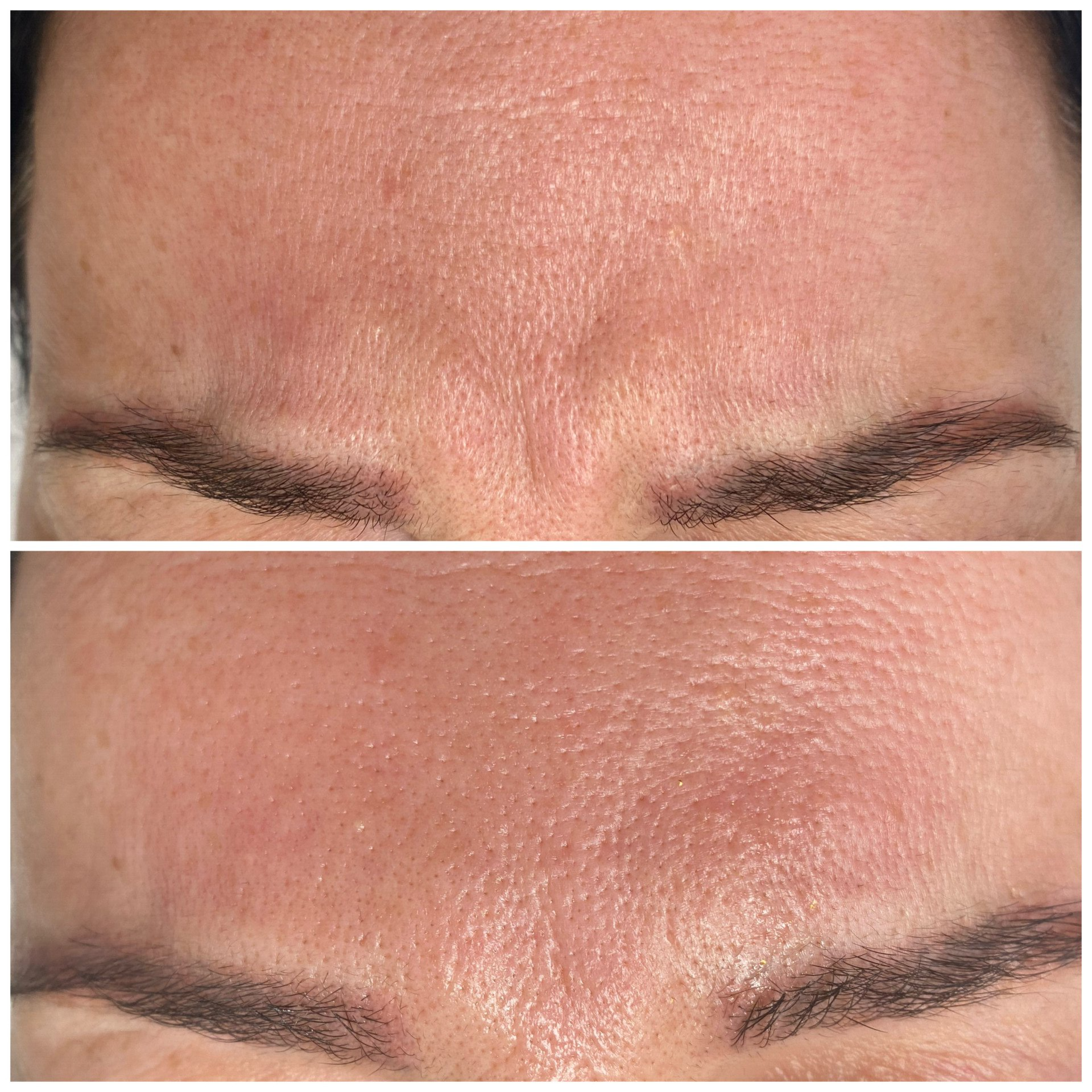 Ein Vorher-Nachher-Foto der Stirn einer Frau