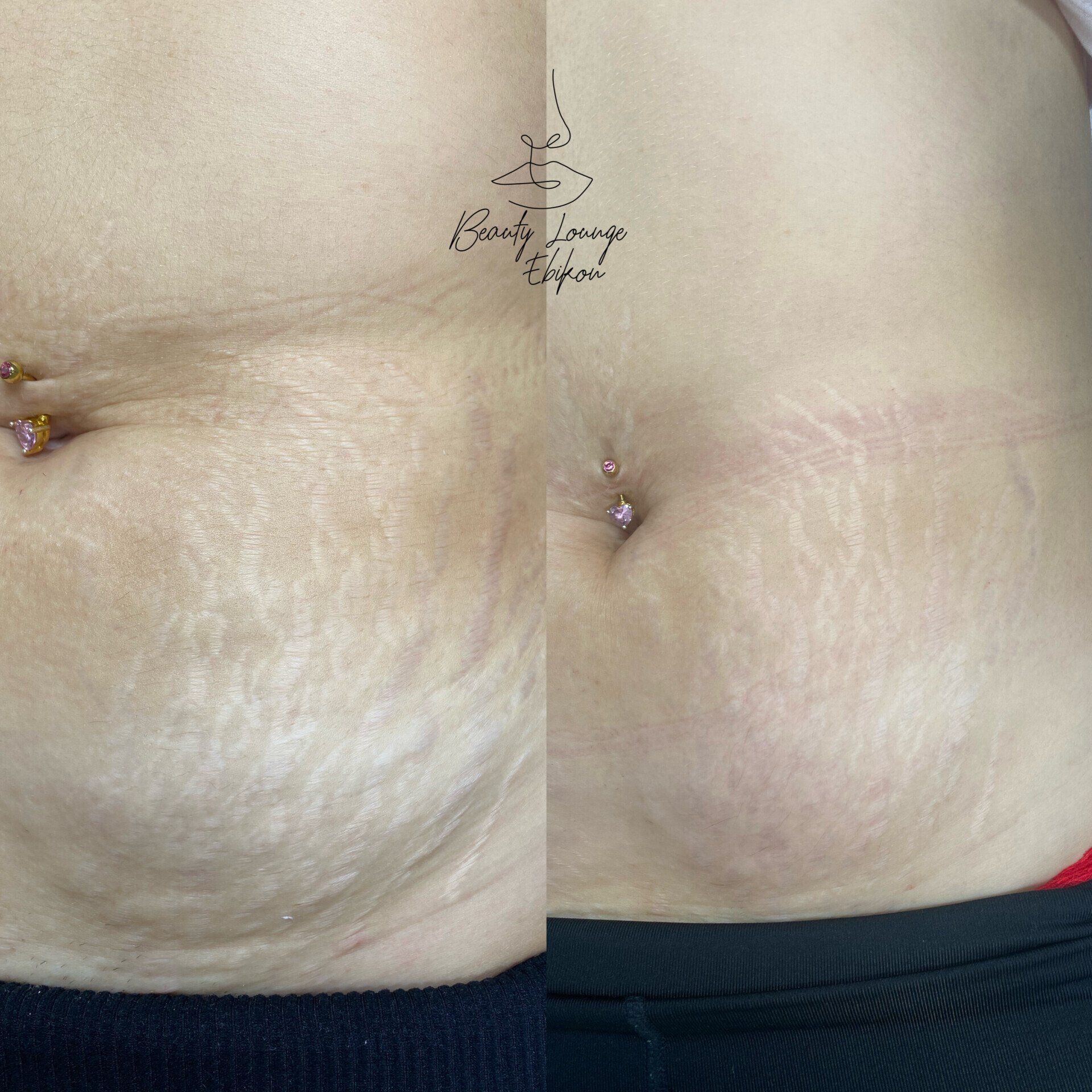 Ein Vorher-Nachher-Foto vom Bauch einer Frau mit Dehnungsstreifen.