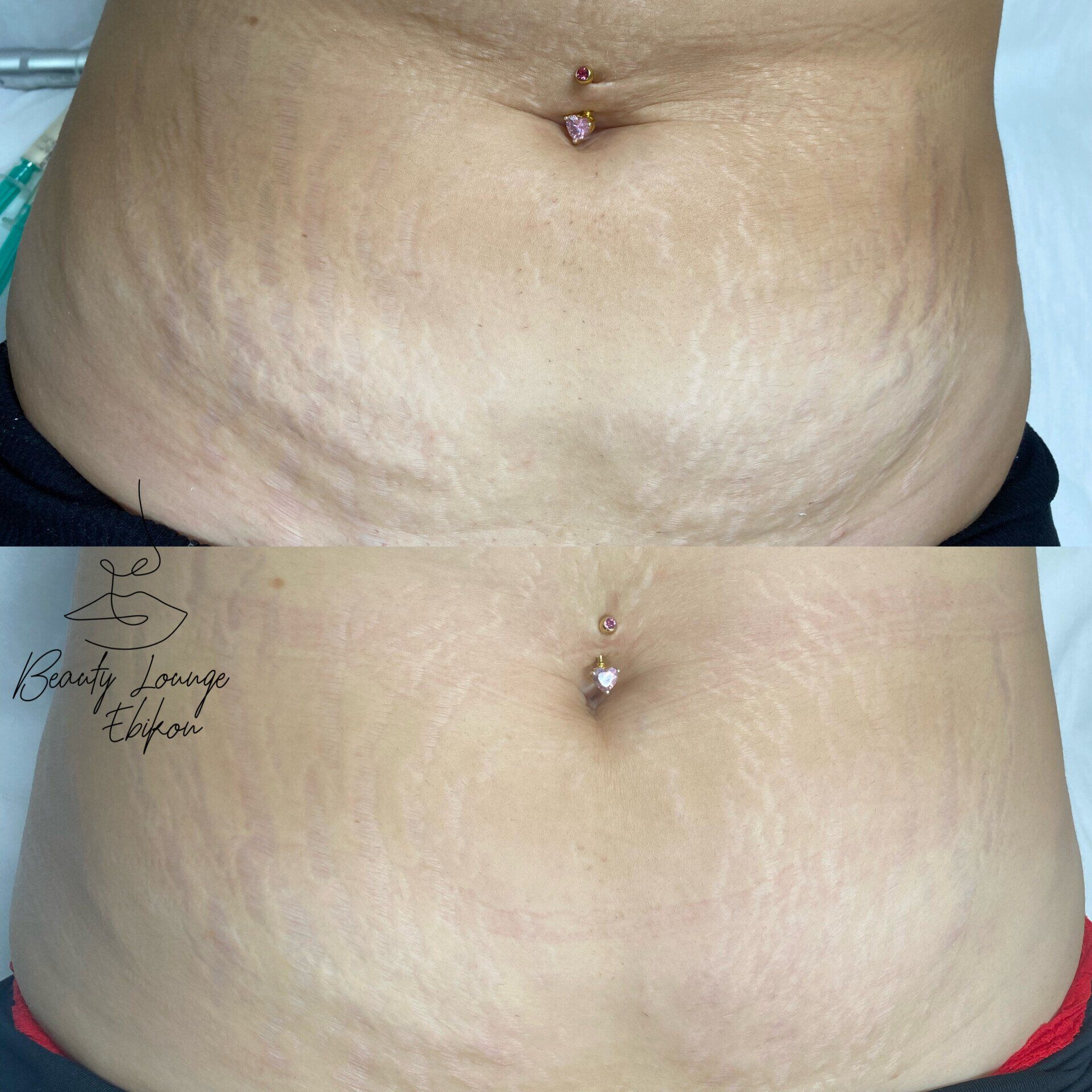 Ein Vorher-Nachher-Foto vom Bauch einer Frau mit Dehnungsstreifen.