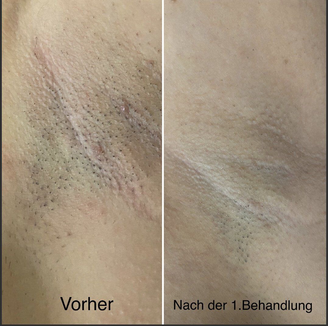Ein Vorher-Nachher-Bild der Achselhöhle einer Person