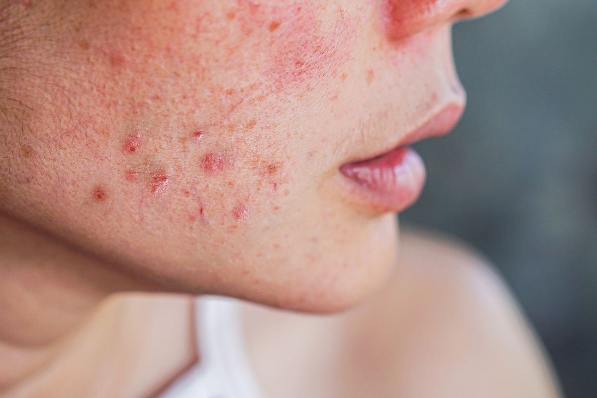 anabolizante-mulher-e-acne-dra-juliana-ribeiro-ginecologista-sao-paulo