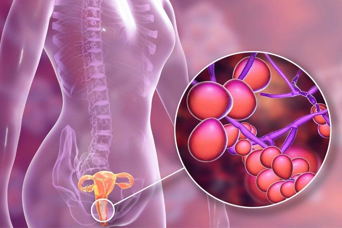 candidiase-dra-juliana-ribeiro-ginecologista-sao-paulo