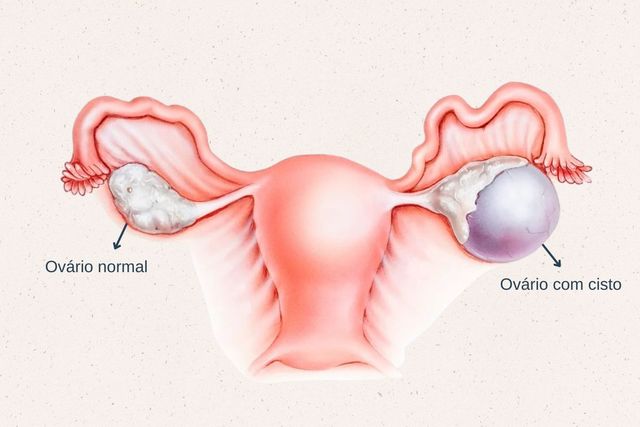 Ooforectomia e Ooforoplastia: causas e tratamentos