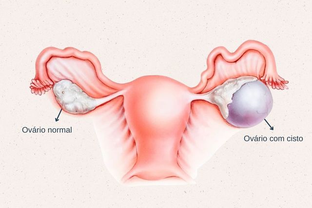 O que é ooforoplastia?