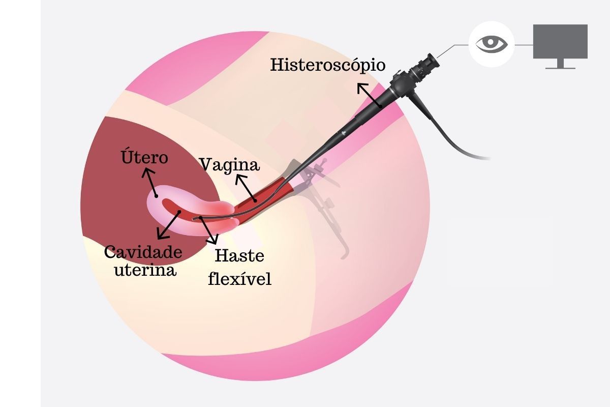 dra-juliana-ribeiro-ginecologista-histeroscopia