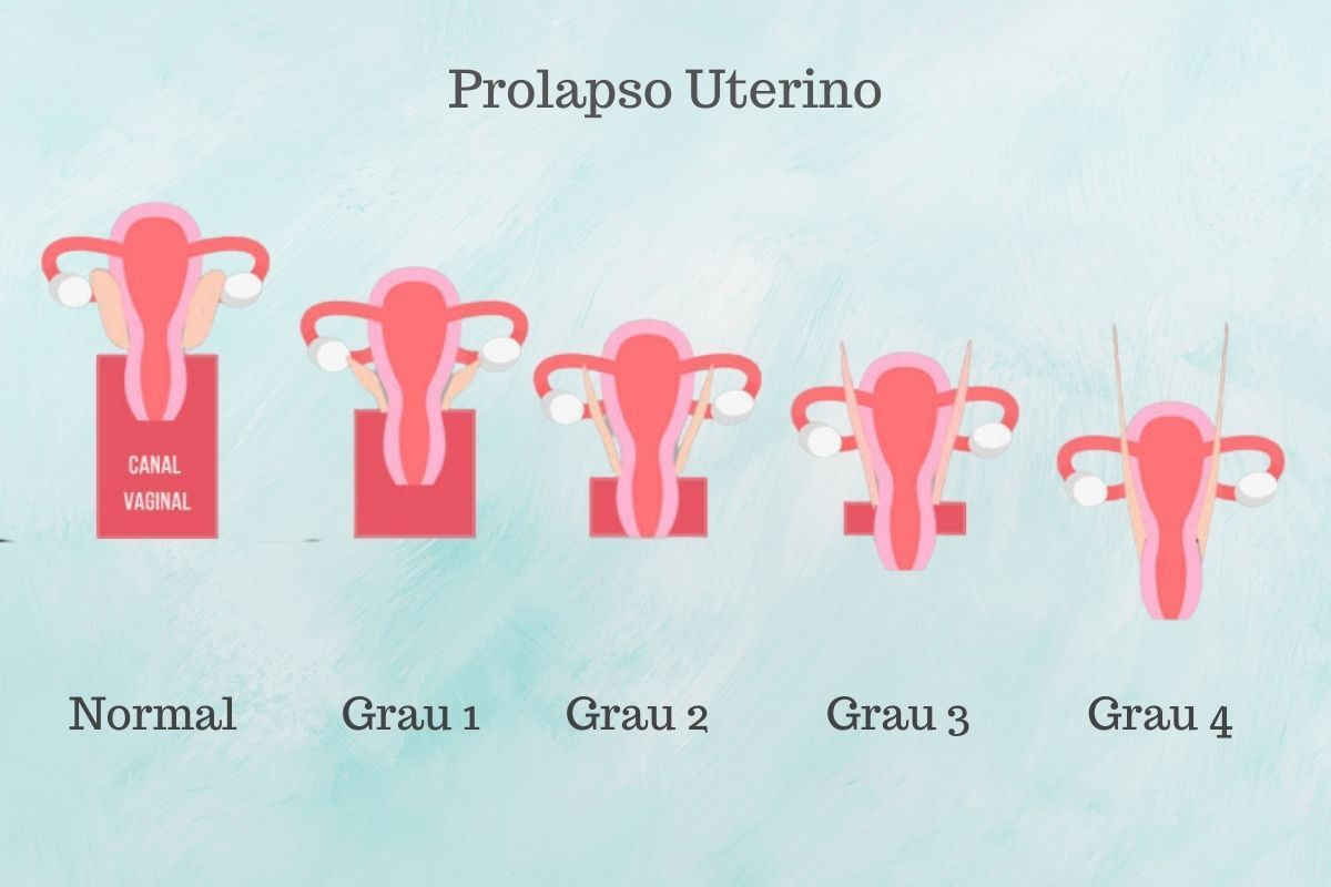 dra-juliana-ribeiro-ginecologista-prolapso-uterino