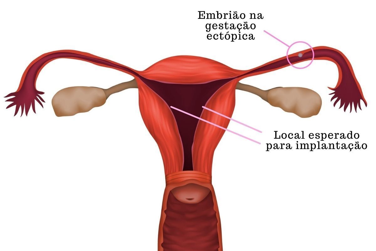 gestacao-tubaria-dra-juliana-ribeiro-obstetra-sao-paulo